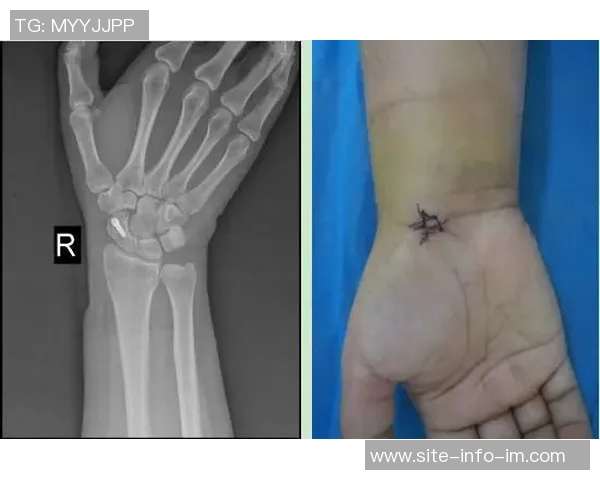 国米官方宣布迪詹纳罗右手腕骨折即将接受手术治疗 国米官方宣布迪詹纳罗右手腕骨折即将接受手术治疗